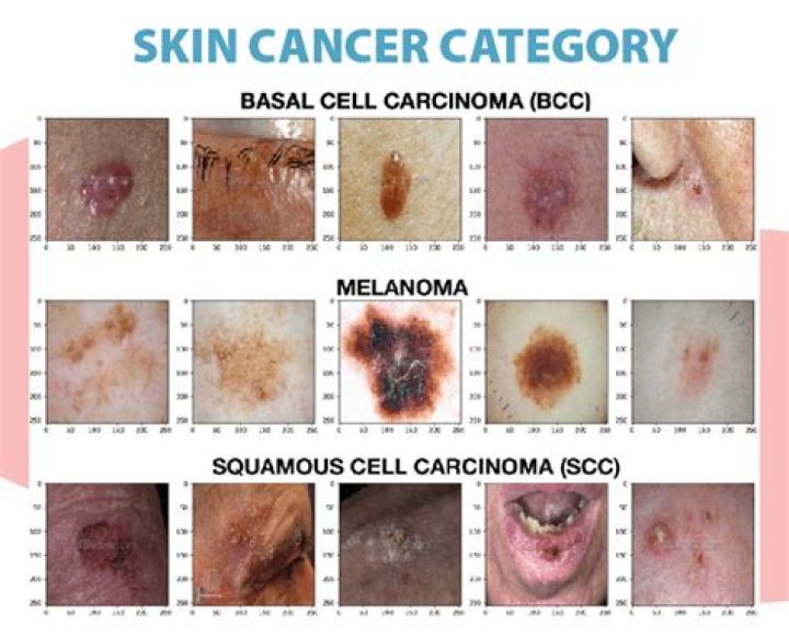 Can skin cancer on the face spread?