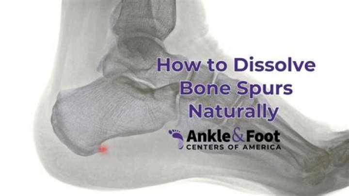 Do bone spurs in the heel go away?