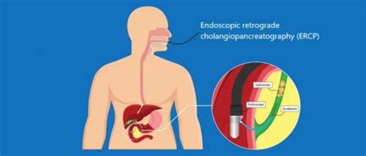 How urgent is an ERCP?