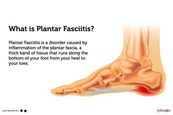 Is diclofenac good for plantar fasciitis?
