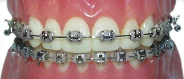 What bands should I get for my braces?