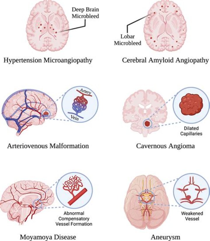 What does parenchymal atrophy mean?