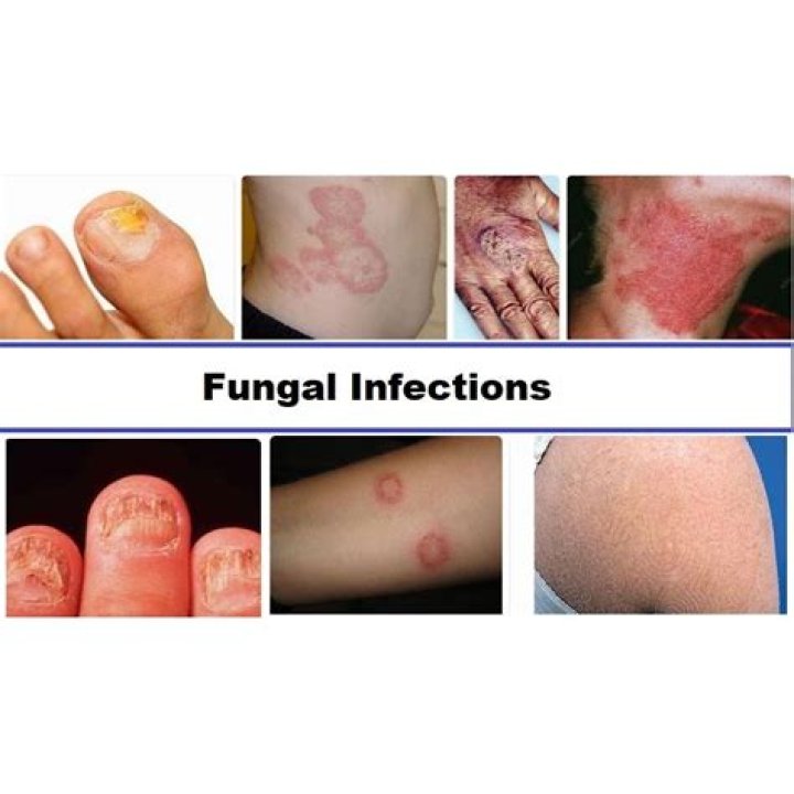 What is superficial fungal infection?