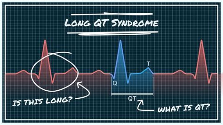 What rhythm is prolonged QT?
