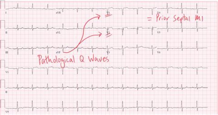 Which leads show posterior wall MI?